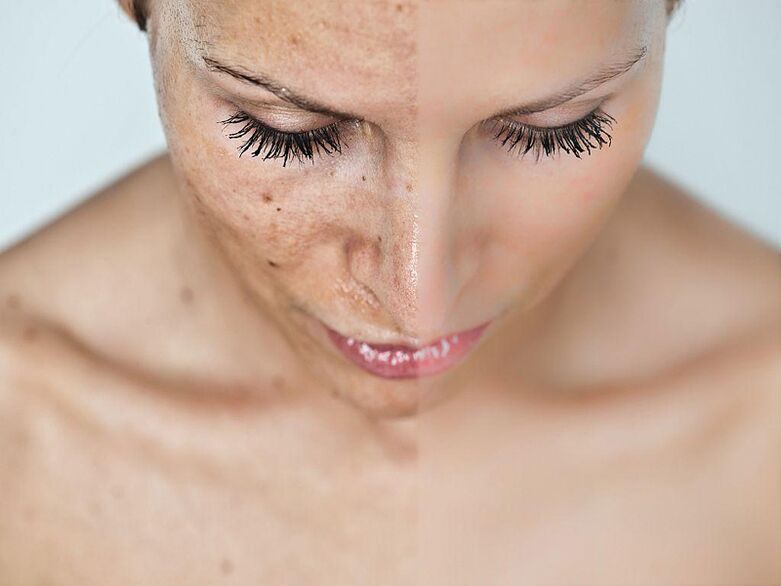 Face before and after the procedures