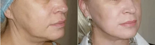 Simple skin rejuvenation