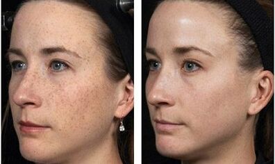 Fractional facial rejuvenation before and after photos