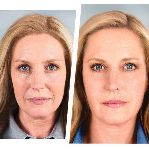 Rejuvenation before and after